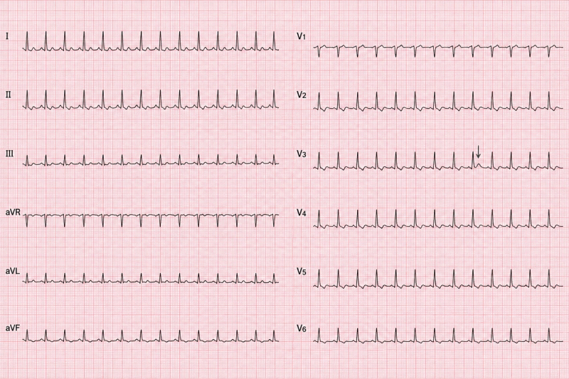 A standard 12-lead ECG recorded during treatment of a metabolic emergency.