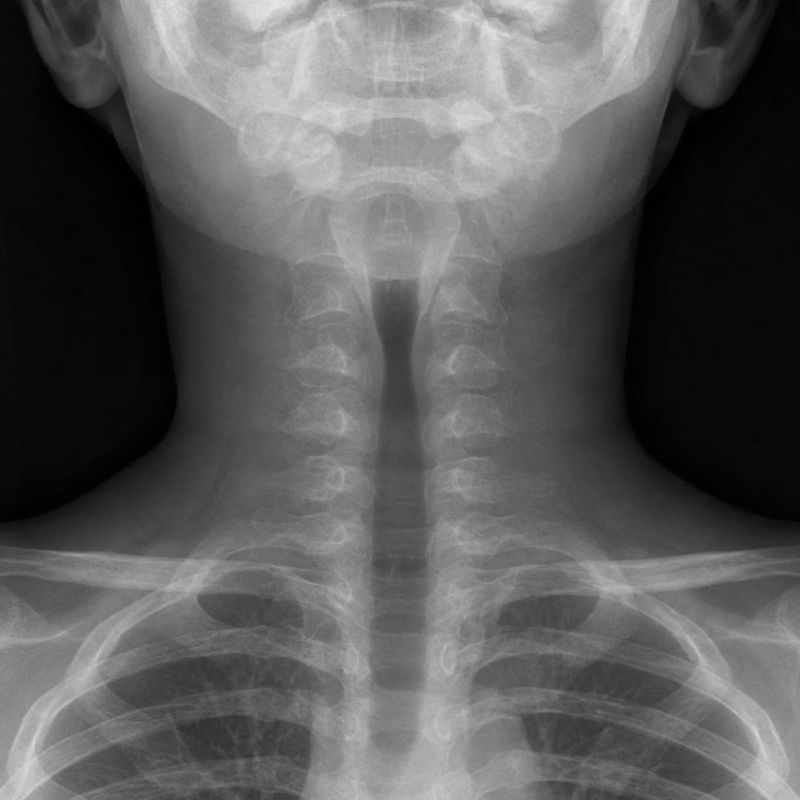 A frontal neck X-ray of a child with a barking cough and stridor.
