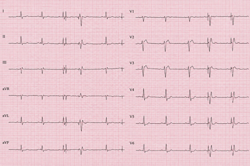 A rhythm strip recorded from a symptomatic patient with an implanted pacemaker.