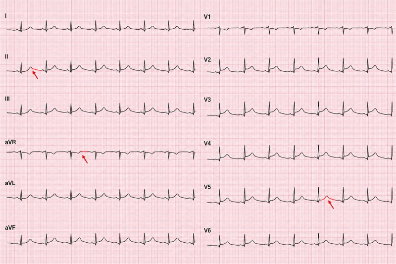 A standard 12-lead ECG obtained during an episode of chest pain.