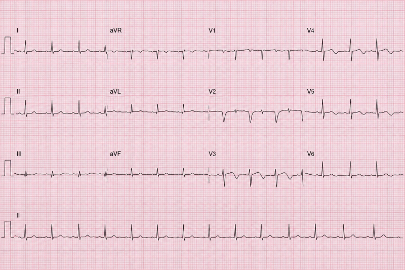 A standard 12-lead ECG recorded while the patient is free of chest pain.