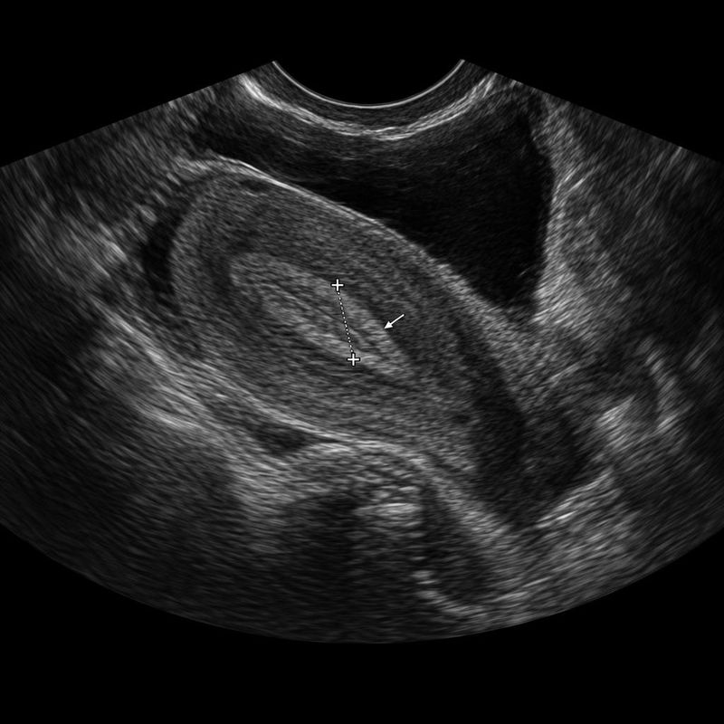 A mid-sagittal transvaginal ultrasound image of a postmenopausal uterus.