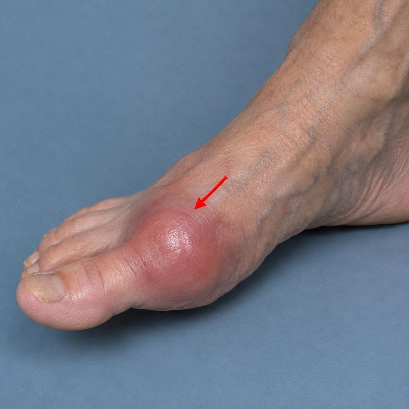 A clinical photograph of an older adult's swollen and red forefoot.