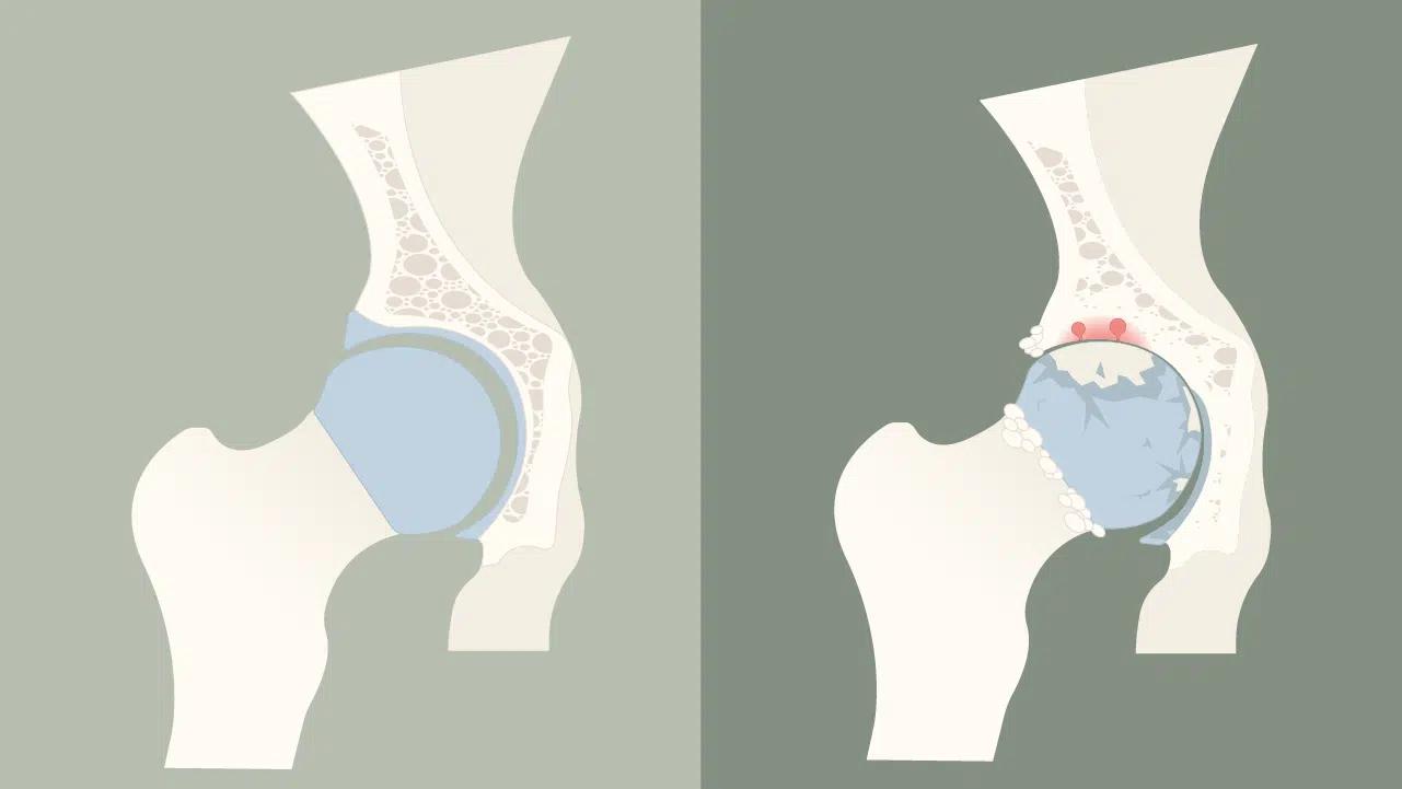 Arthrodese - knstliche Gelenkversteifung | Liebscher & Bracht