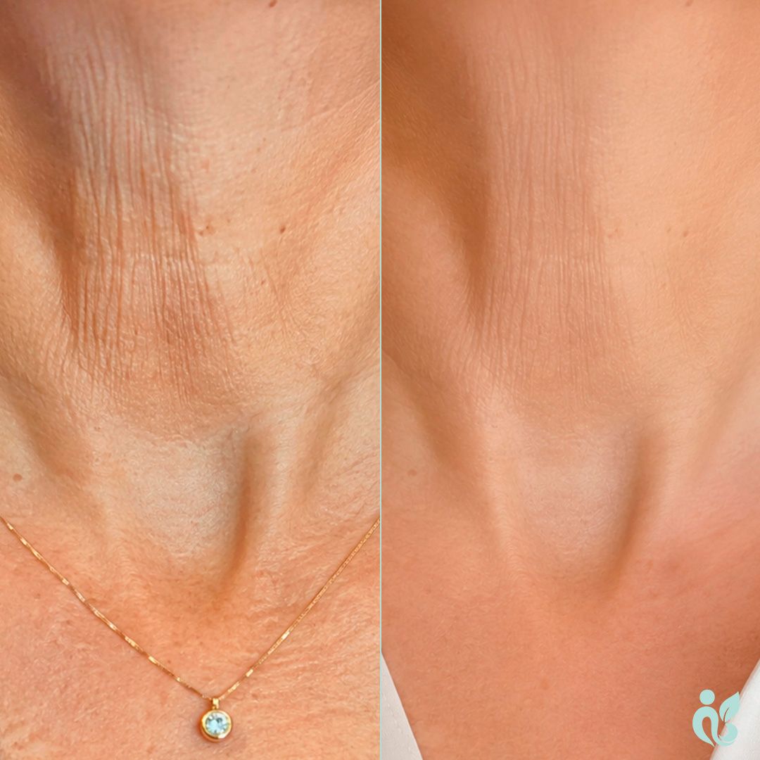 NECKLIFT