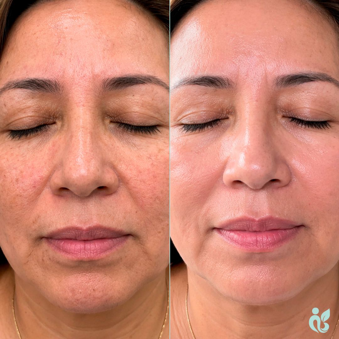 Facial Antiaging