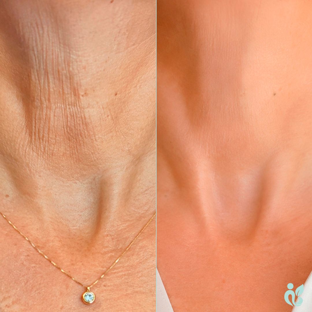 NECKLIFT