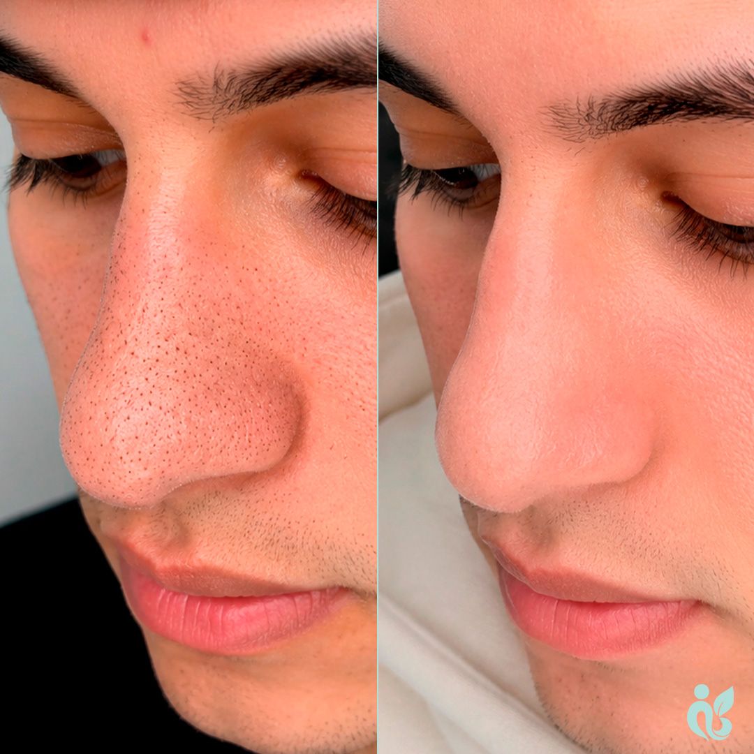 Facial Limpieza Profunda
