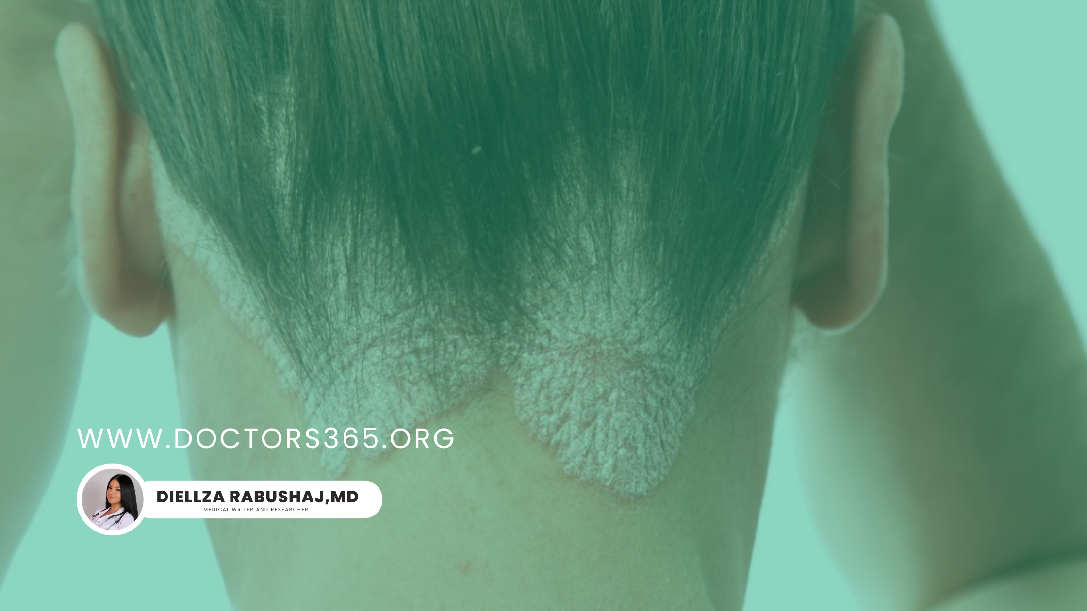 Psoriasis Symptoms and Online Dermatologist Help