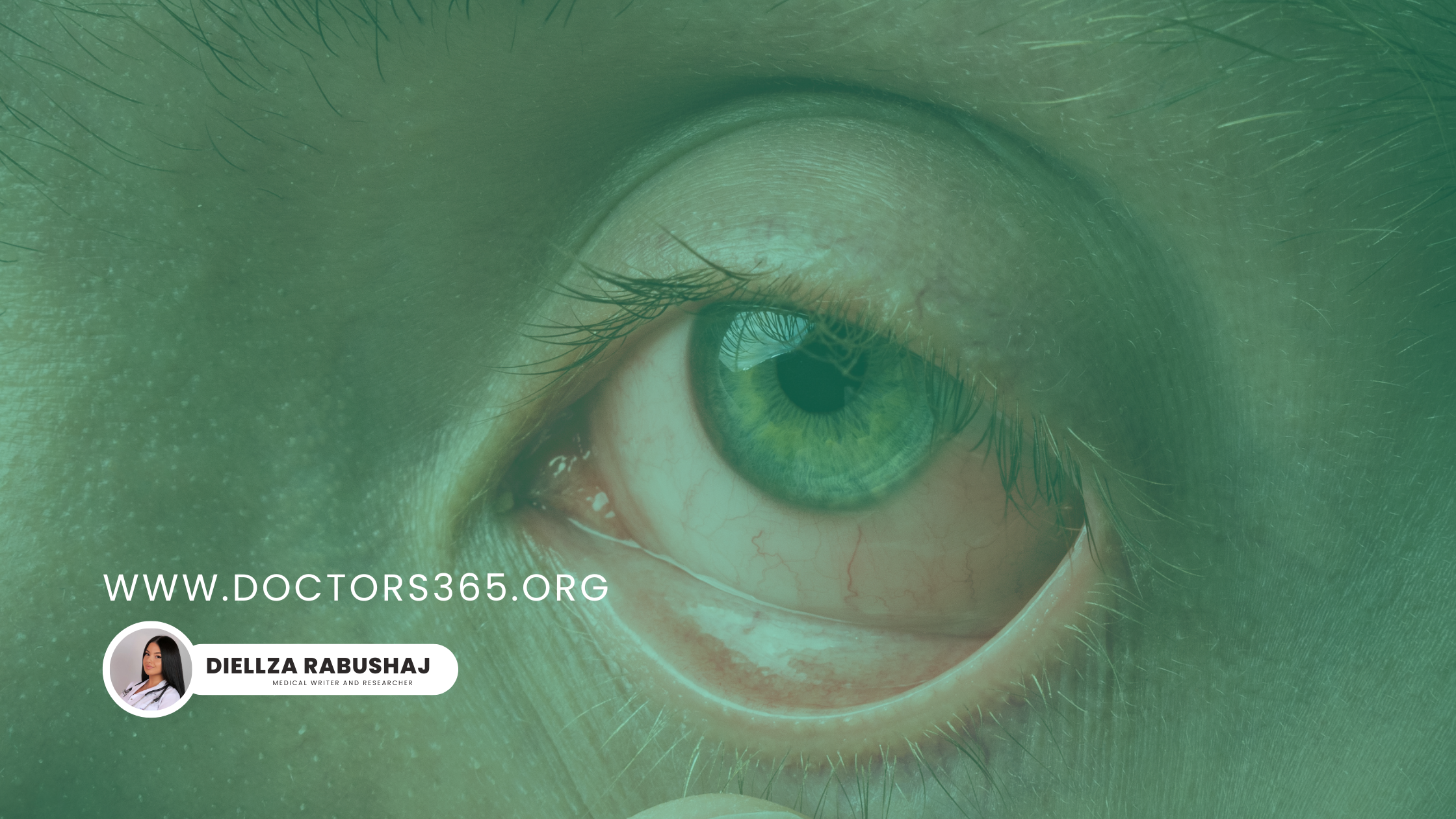 Conjunctivitis (Pink Eye)