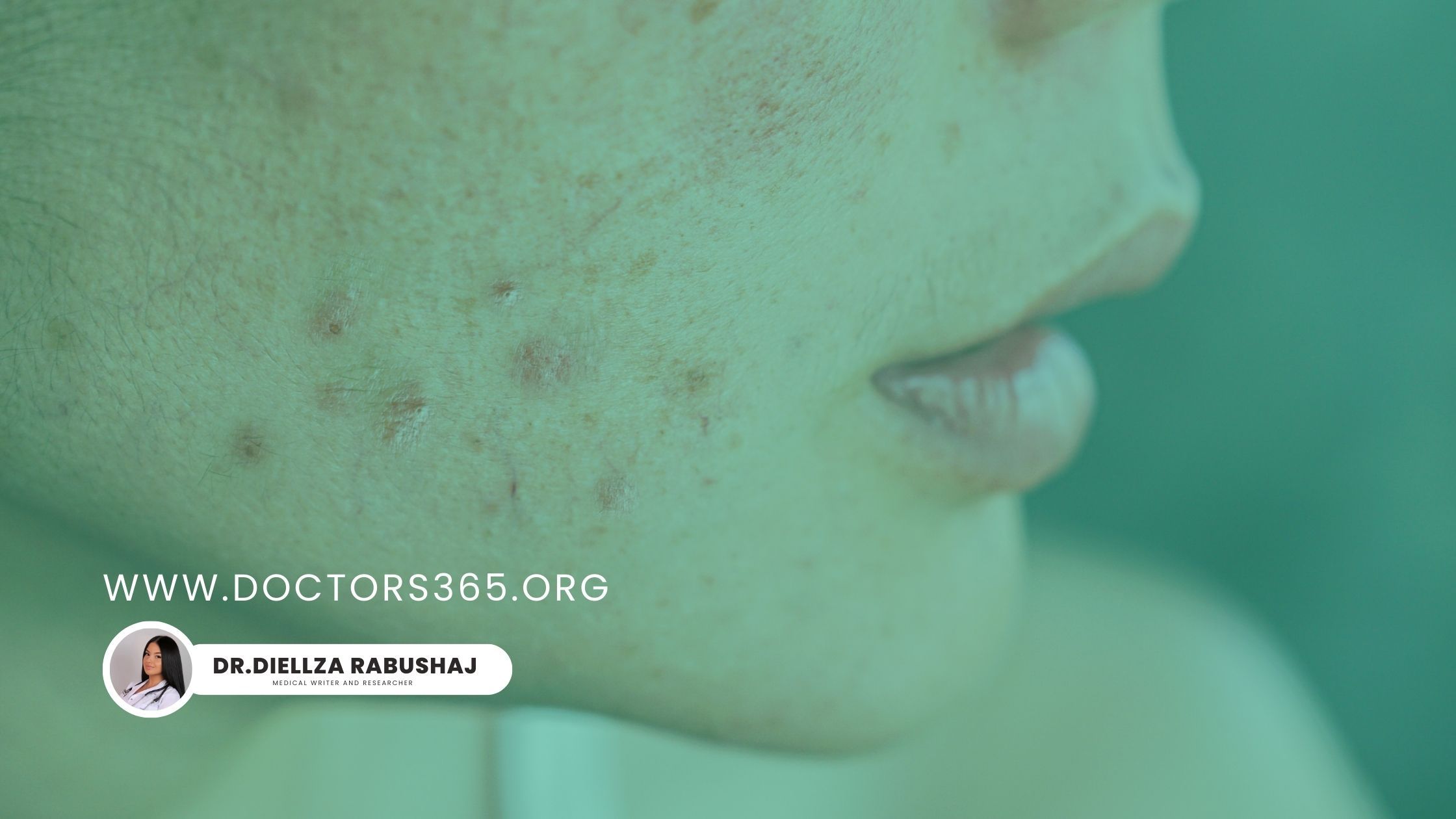 The New Era of Acne Treatment