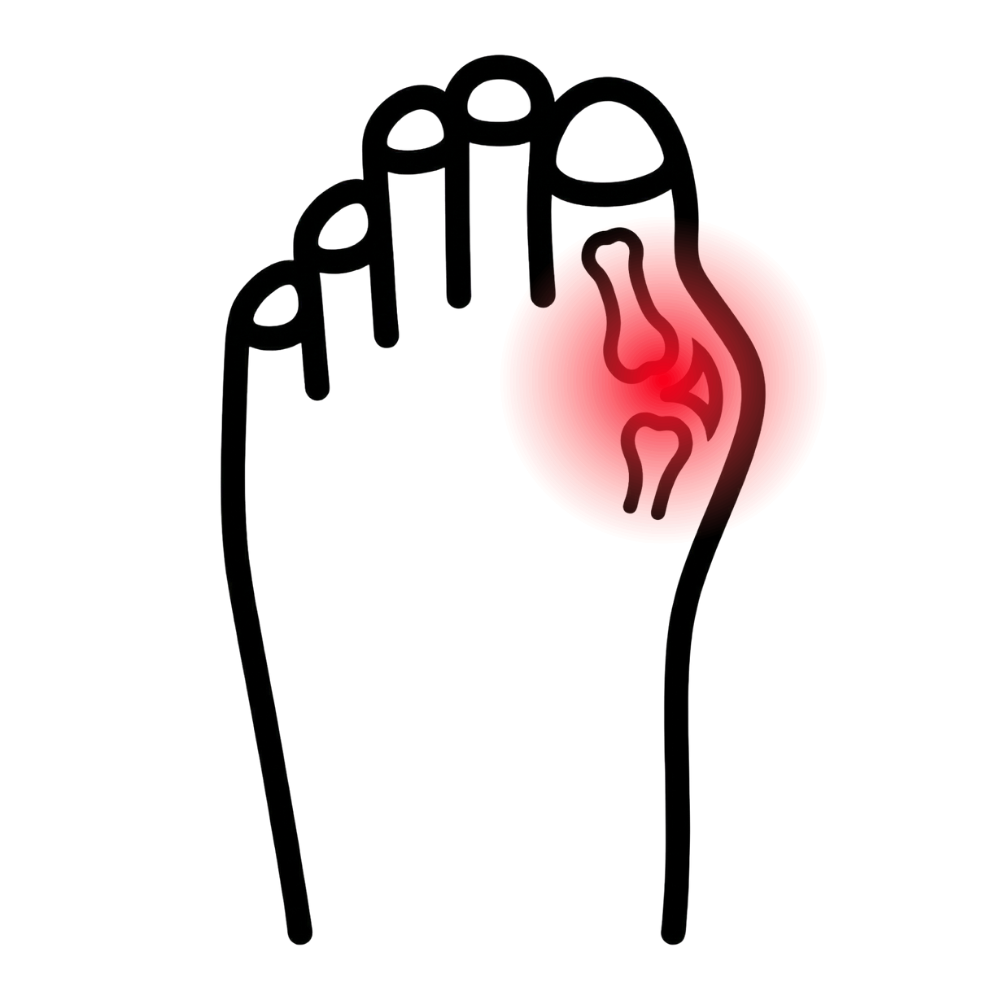 Hallux valgus