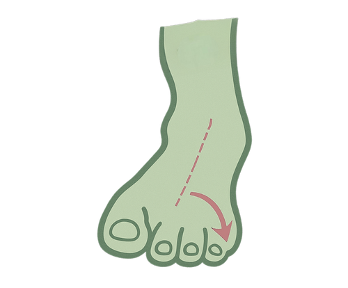 Overpronation Shoes