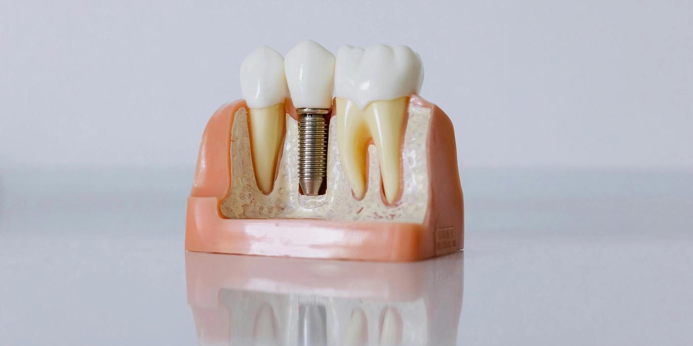 Dental implant diagram showing titanium post in jawbone