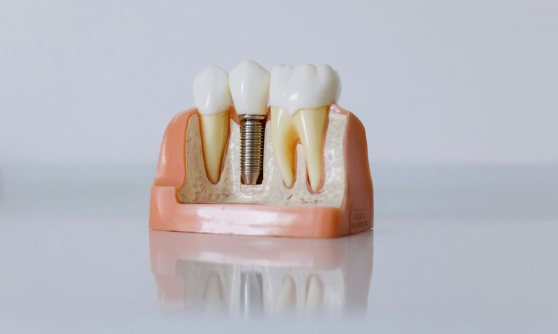 Dental implant diagram showing titanium post in jawbone