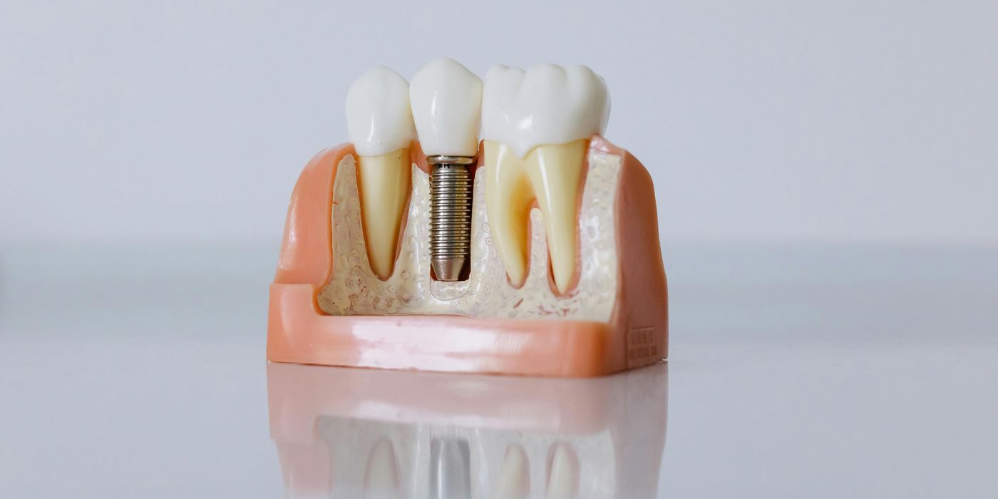 Dental implant diagram showing titanium post in jawbone