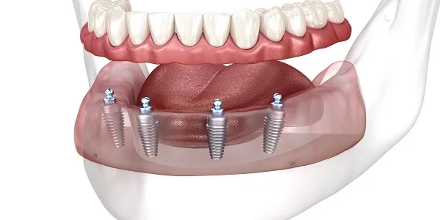 All-on-4 dental implant model showing four implants supporting full arch