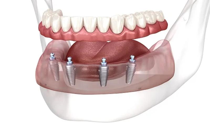 All-on-4 dental implant model showing four implants supporting full arch
