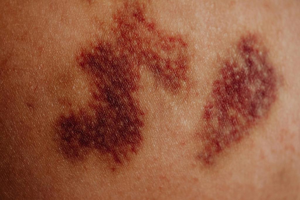 birth-mark