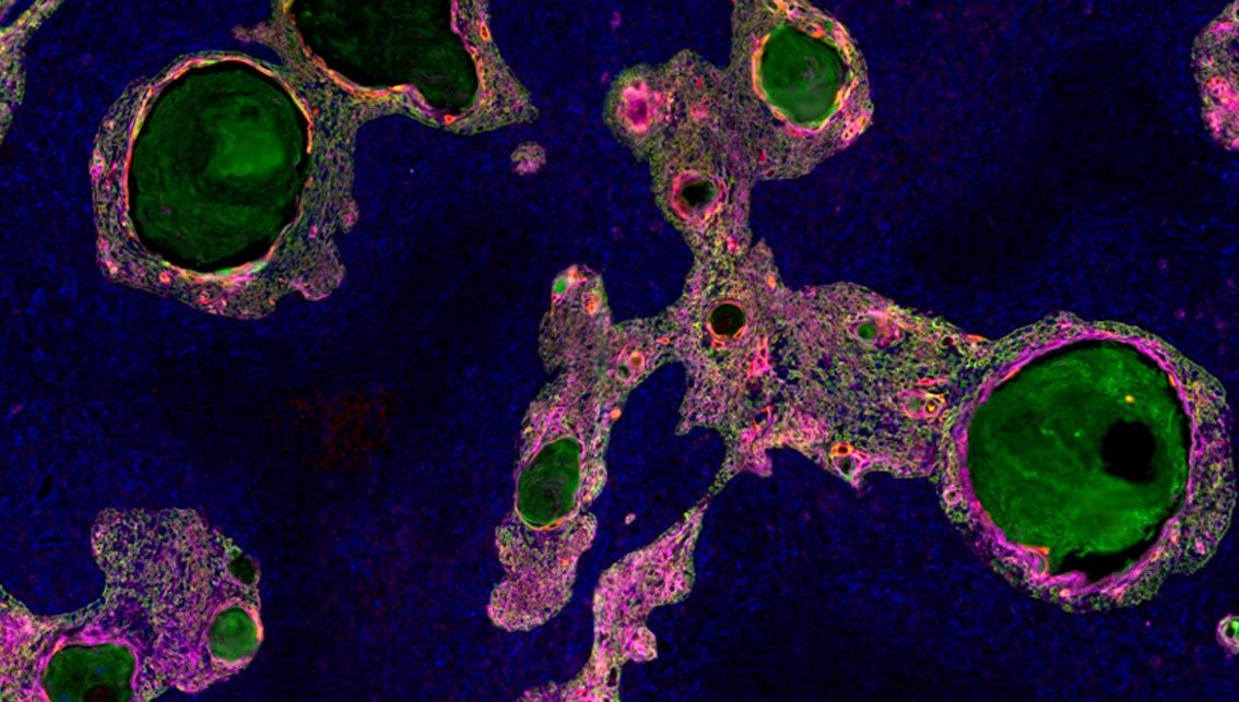 Non-Small Cell Lung Cancer tumor microenvironment profiling