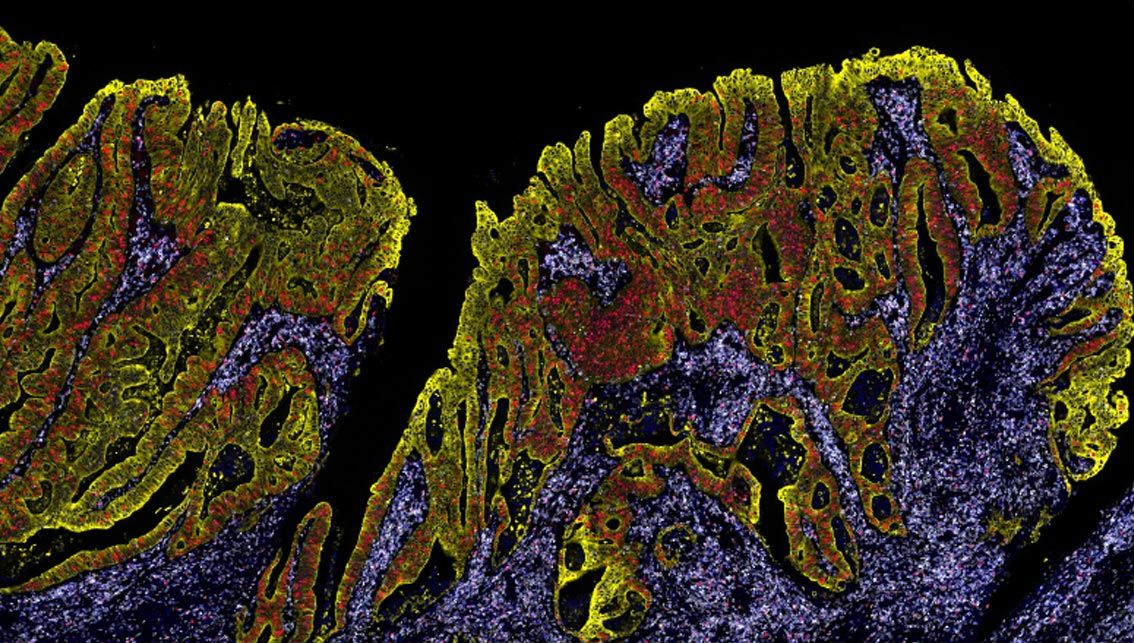 Non-Small Cell Lung Cancer tumor microenvironment profiling