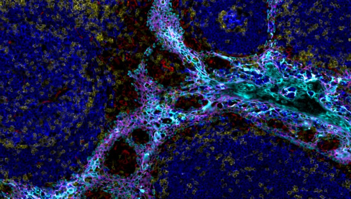 Non-Small Cell Lung Cancer tumor microenvironment profiling