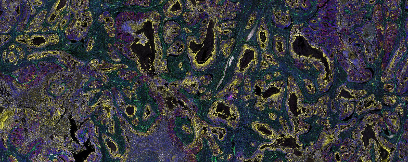 Spatial Profiling Uncovers Immune Correlates of Durable Response in Phase 1/2 MSS Colorectal Cancer Trial — Research Spotlight
