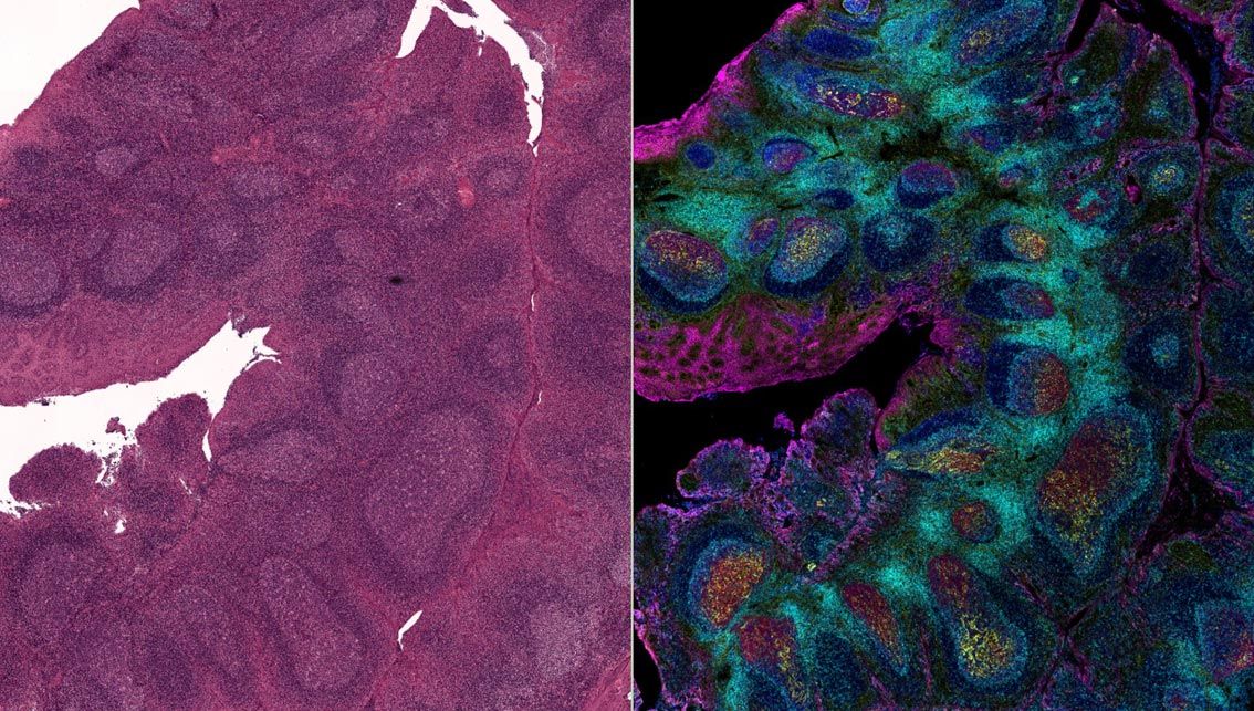 The Path to Clinical Relevance: Moving from Spatial Transcriptomics to Protein Profiling — Blog