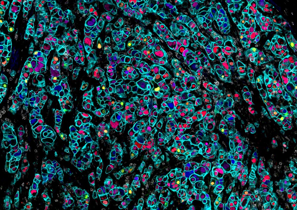 Human Breast Invasive Ductal Carcinoma