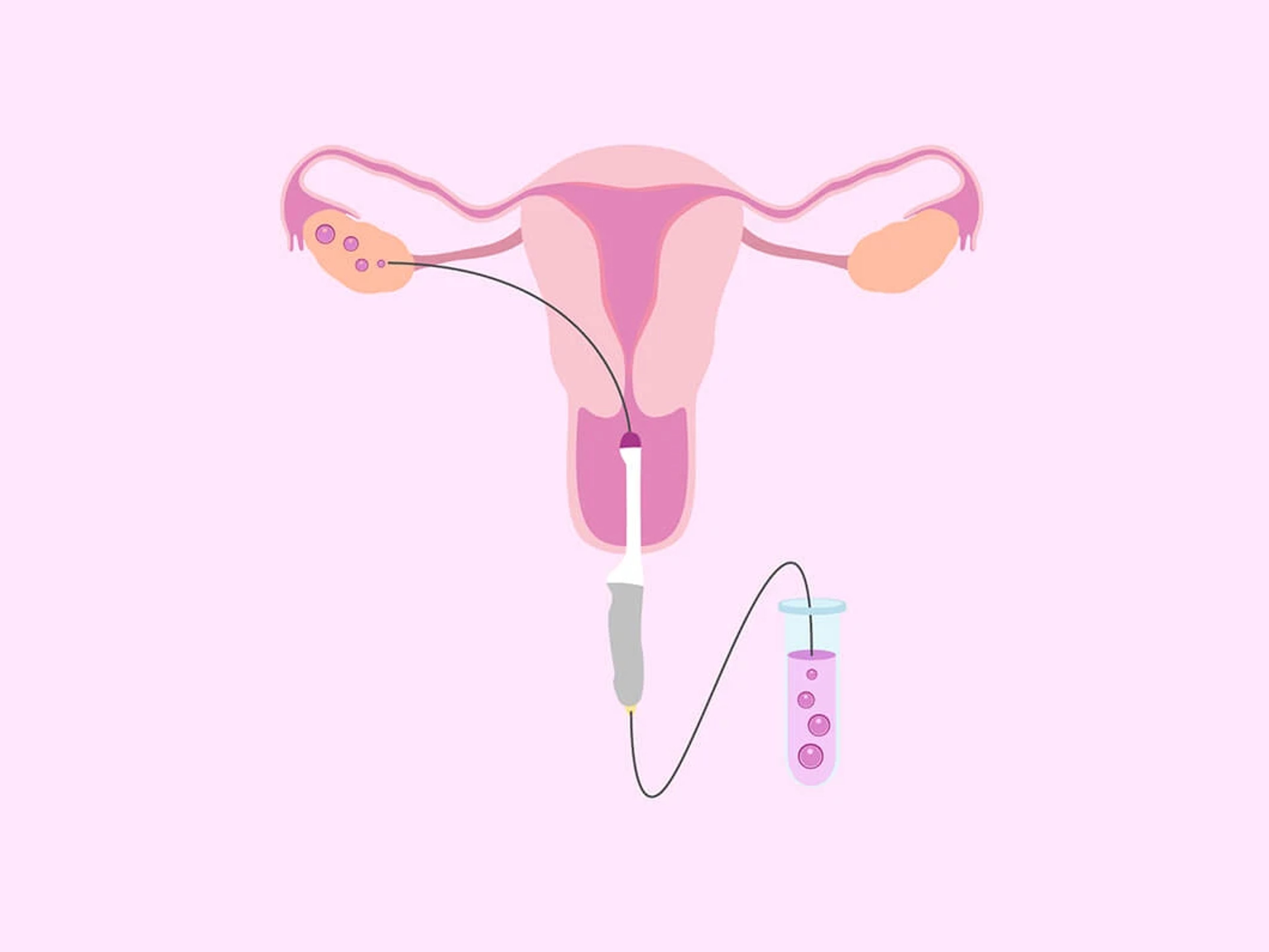 What to Expect Before, During and After Egg Retrieval