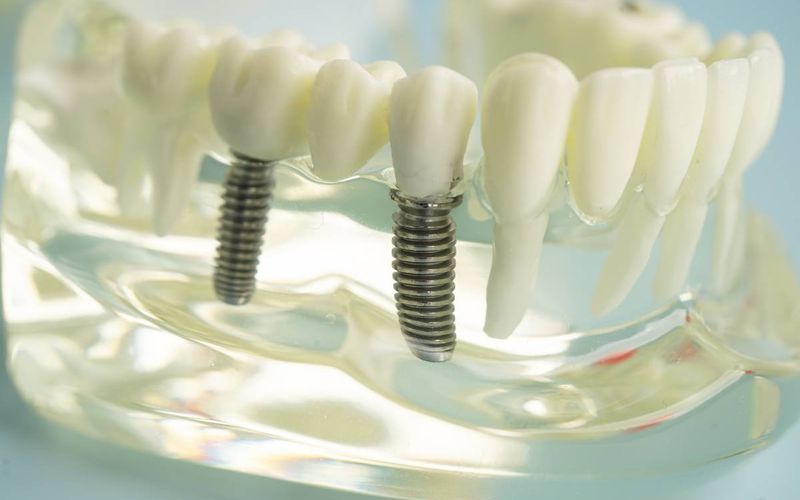 Can I Use FSA For Dental Implants?