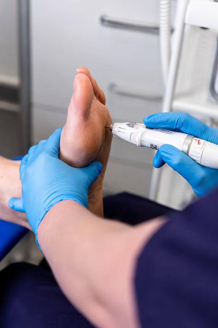 Verruca and wart treatment at Active Step, Fareham