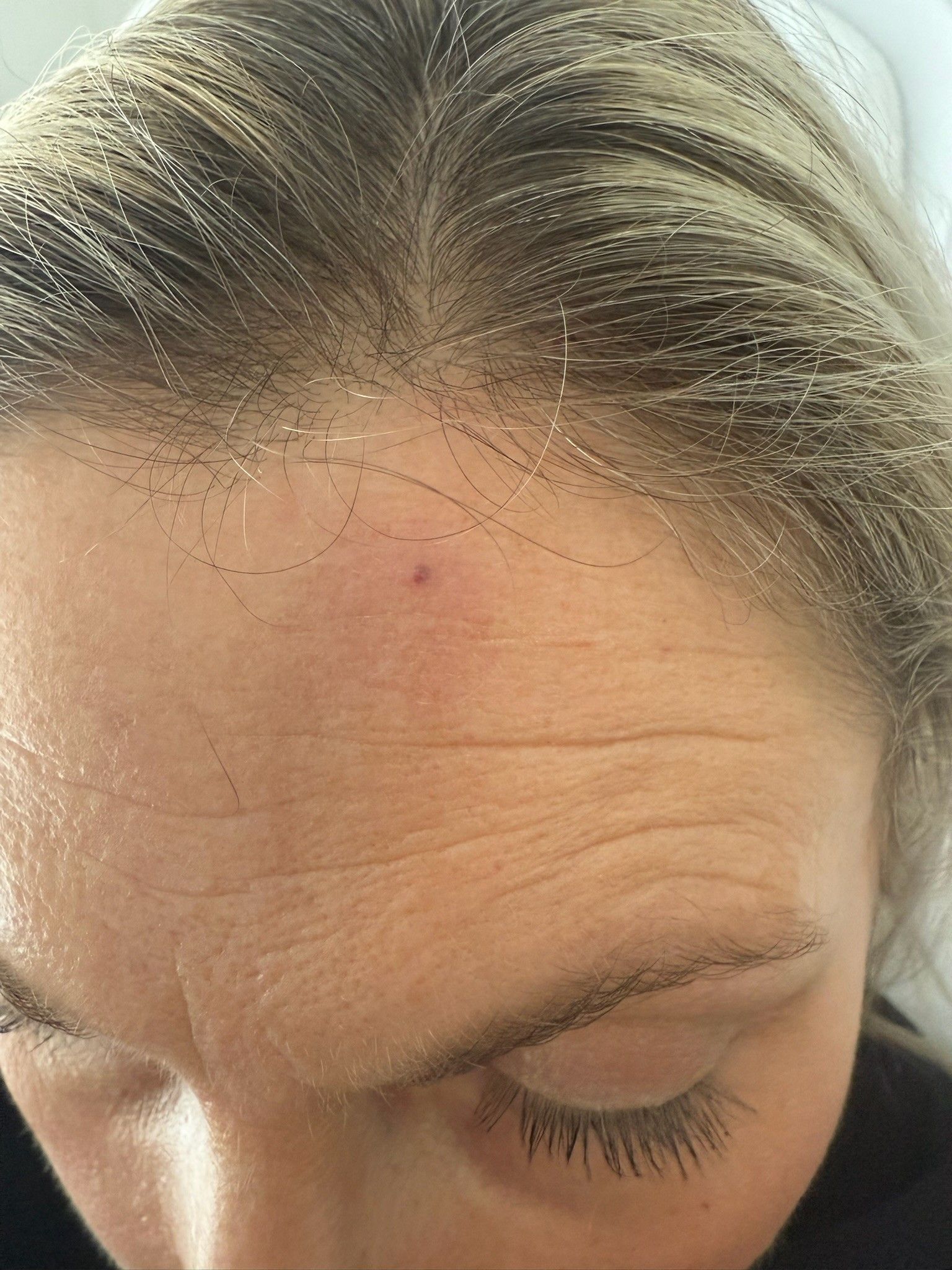 Nahaufnahme eines Hautareals mit Pigmentveränderungen, MySilkSkin Rheda-Wiedenbrück.