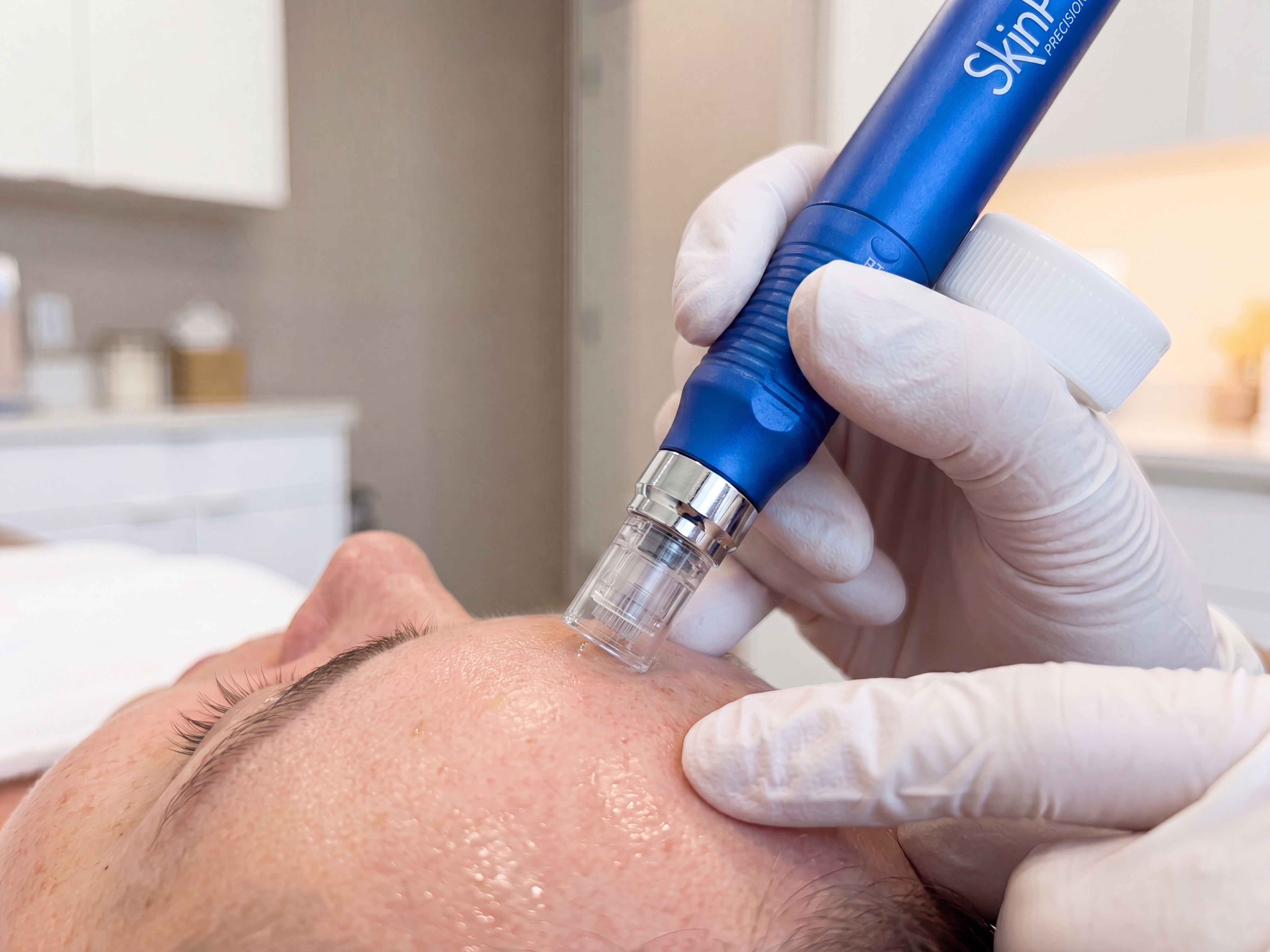 Nahaufnahme: Der SkinPen Precision wird bei der Microneedling-Behandlung an der Stirn aufgesetzt.