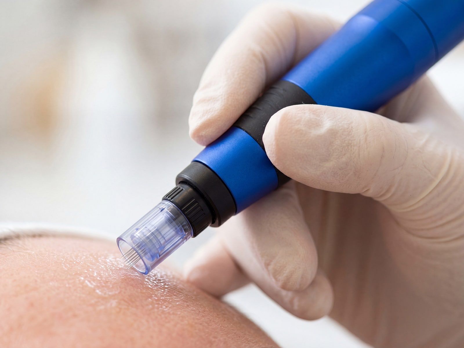 SkinPen Precision Elite bei der Microneedling-Behandlung im MySilkSkin Studio Rheda-Wiedenbrück