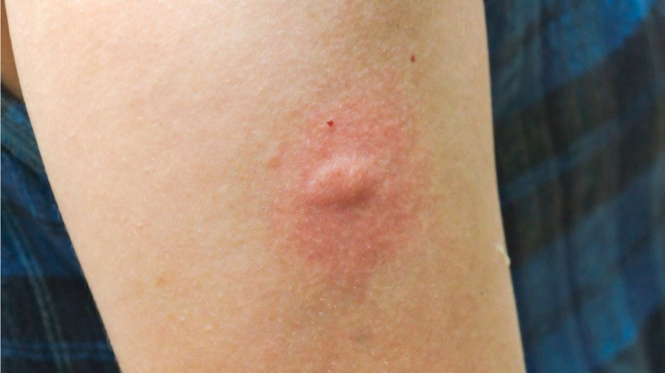 Scrub typhus fever and rash evaluation in Hyderabad