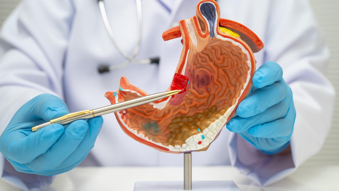 Peptic ulcer stomach pain evaluation in Hyderabad