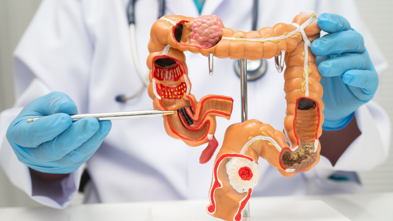IBS bowel irregularity and gut evaluation in Hyderabad