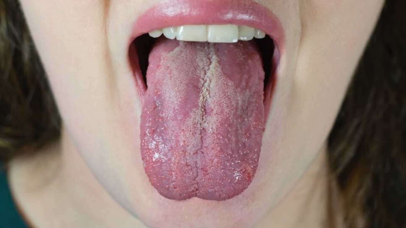 Candidiasis oral and skin infection evaluation in Hyderabad