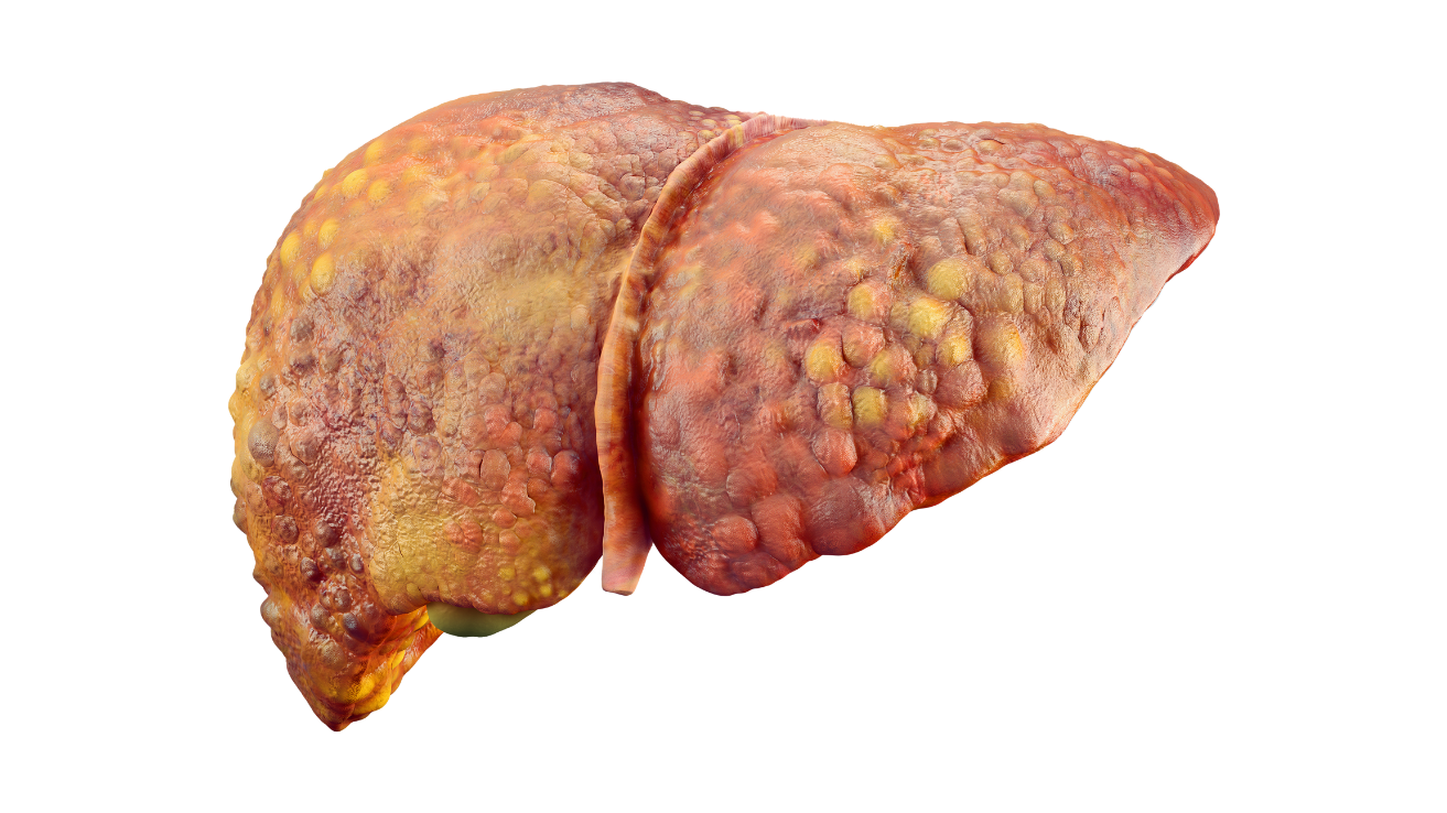 Fatty liver disease evaluation and care in Hyderabad