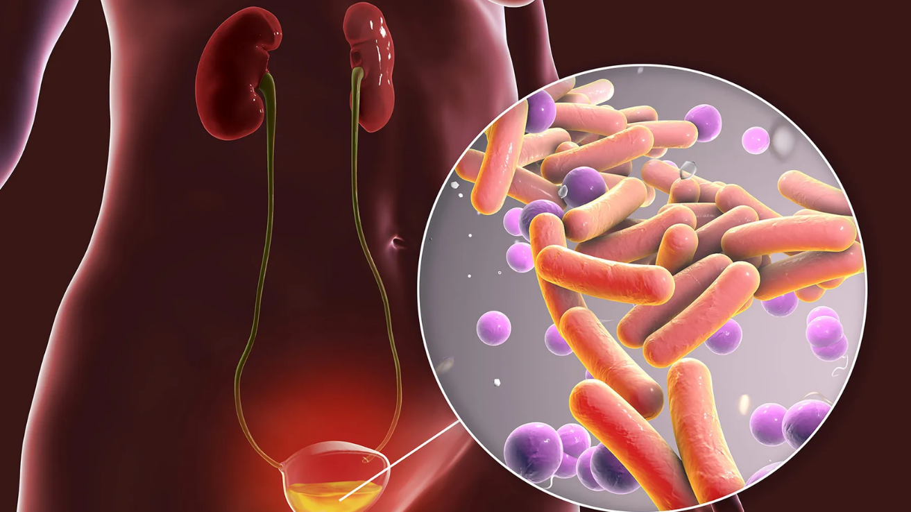 Urine infection consultation and diagnosis in Hyderabad