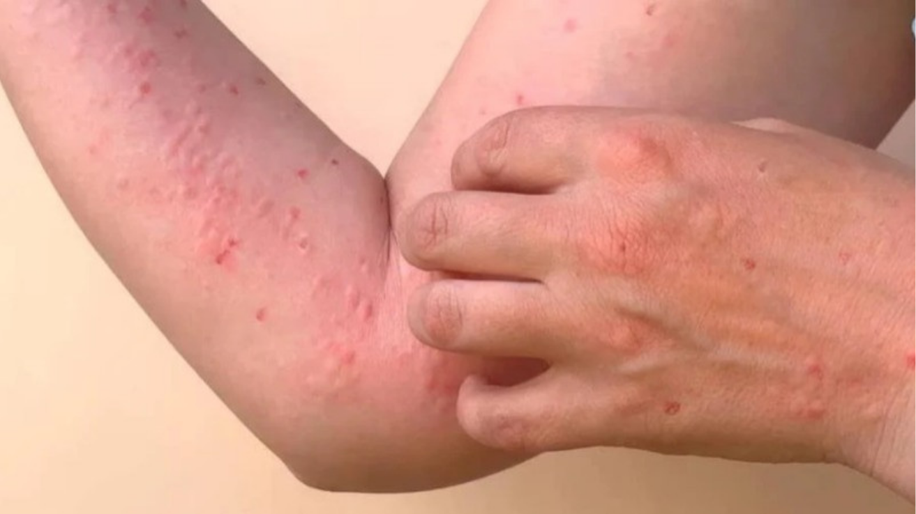 Chikungunya fever and joint pain evaluation in Hyderabad