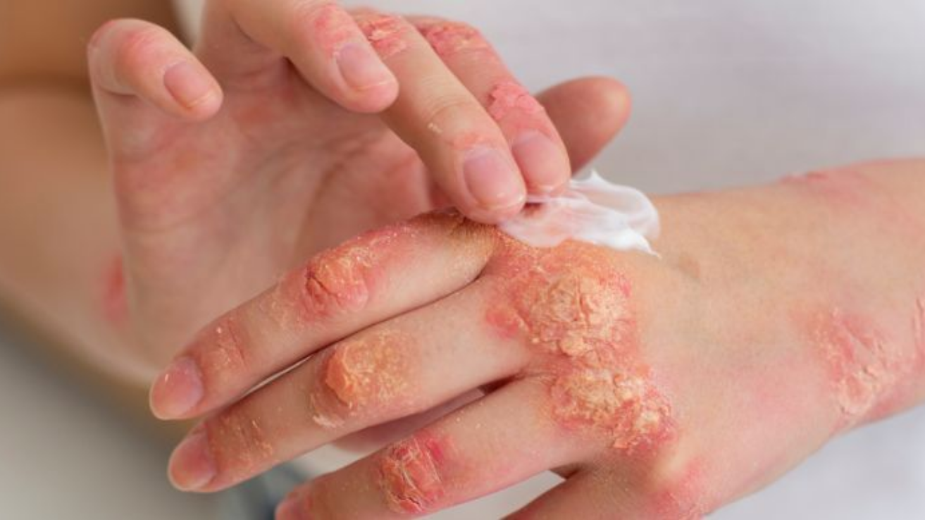 Fungal infection skin and nail evaluation in Hyderabad