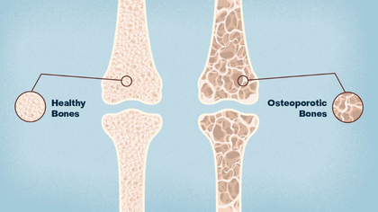 Osteoporosis bone density evaluation in Hyderabad