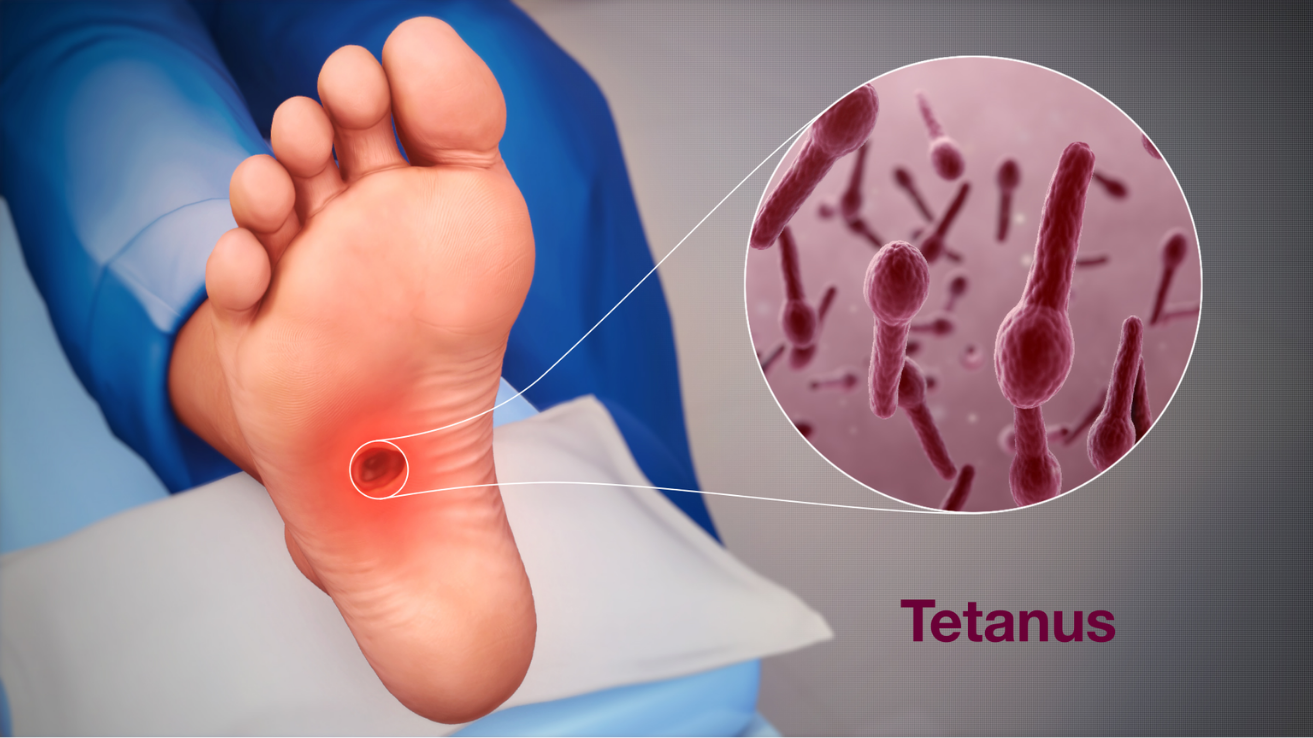 Tetanus wound care and vaccine evaluation in Hyderabad