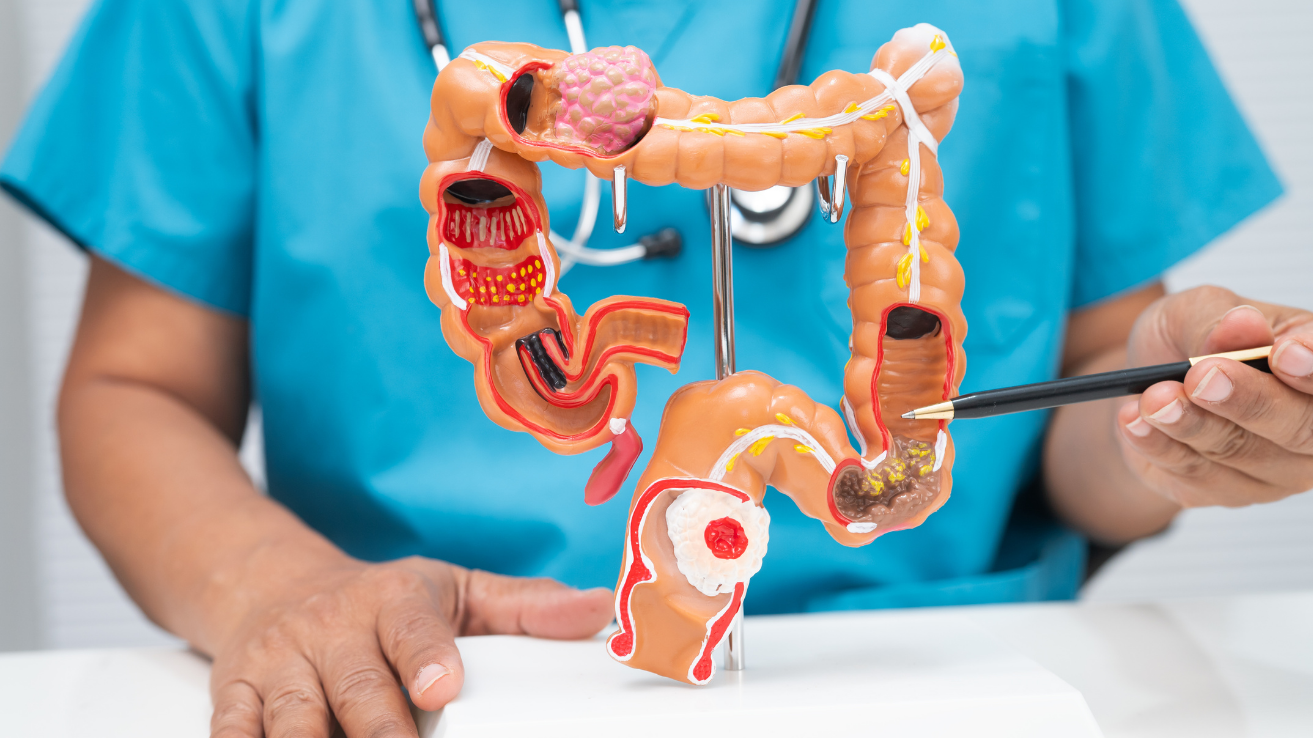 Ulcerative colitis bowel inflammation evaluation in Hyderabad