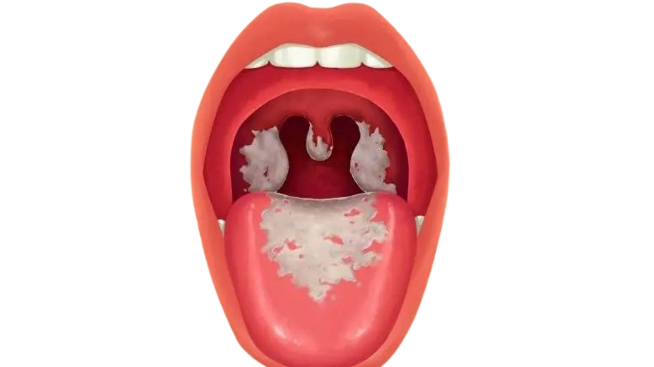 Diphtheria throat infection evaluation in Hyderabad