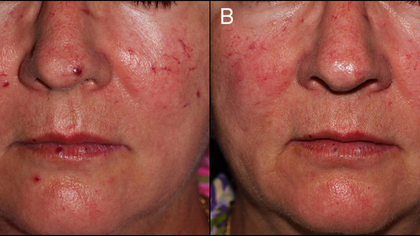 Hereditary haemorrhagic telangiectasia (HHT) evaluation in Hyderabad