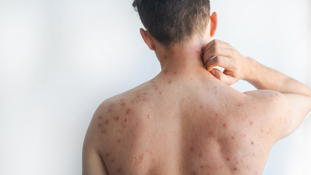 Measles rash and fever evaluation in Hyderabad
