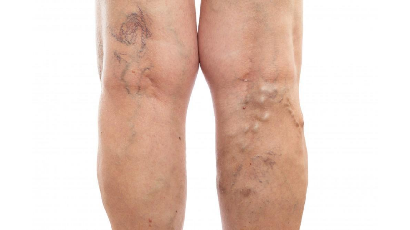 Deep vein thrombosis (DVT) leg clot evaluation in Hyderabad